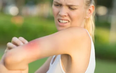 Vrouw bekijkt een insectenbeet op haar arm