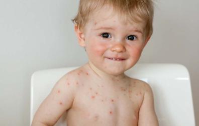 Jongetje met waterpokken over zijn gehele lijf