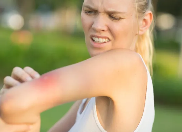 Een vrouw krabt aan een insectenbeet op haar arm